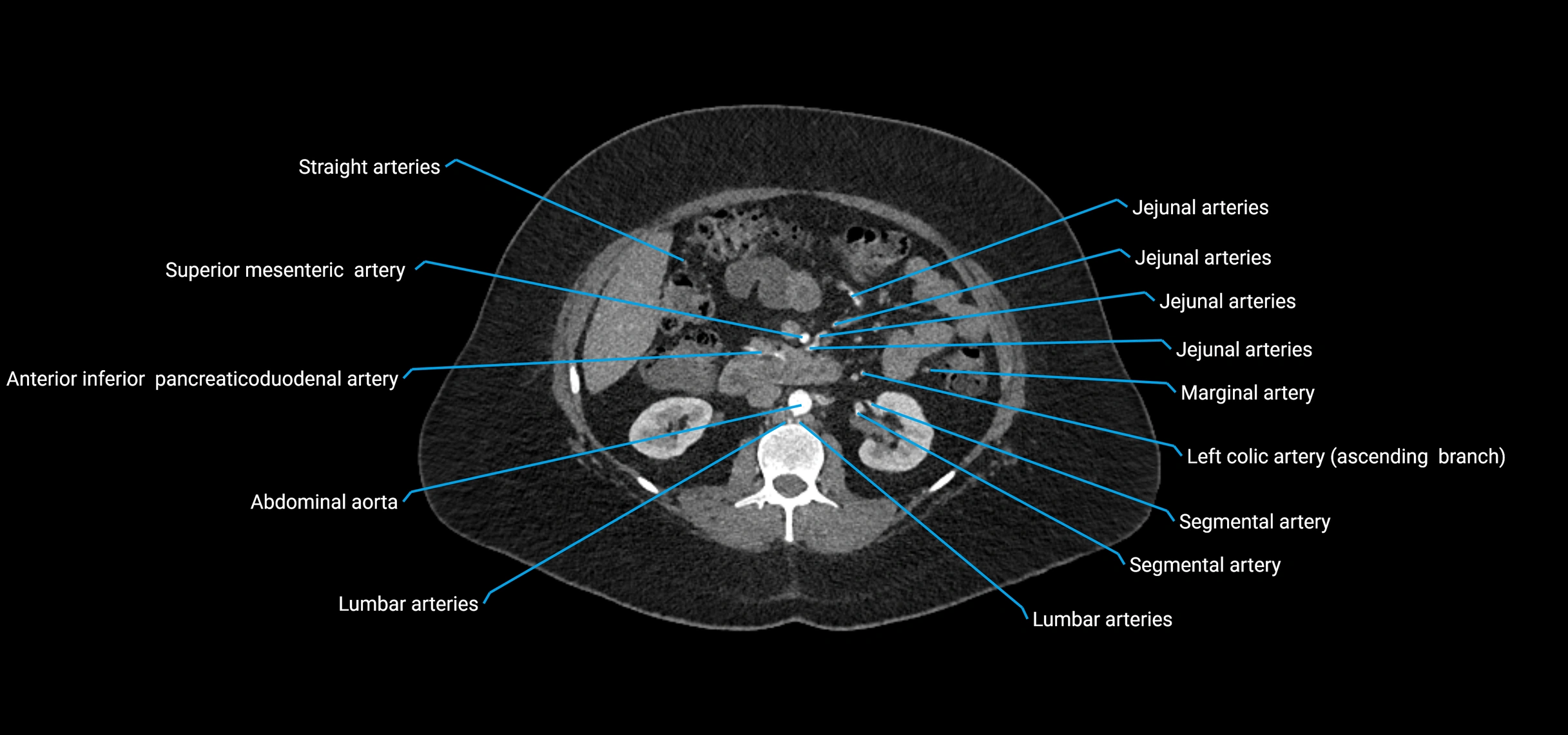 CTA abdomen axial cross sectional anatomy labelled image_80 (2).webp
